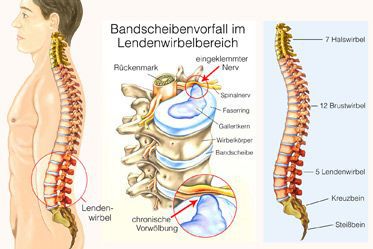 Fitnessstudio Dresden Perfect Body - Der Bandscheibenvorfall